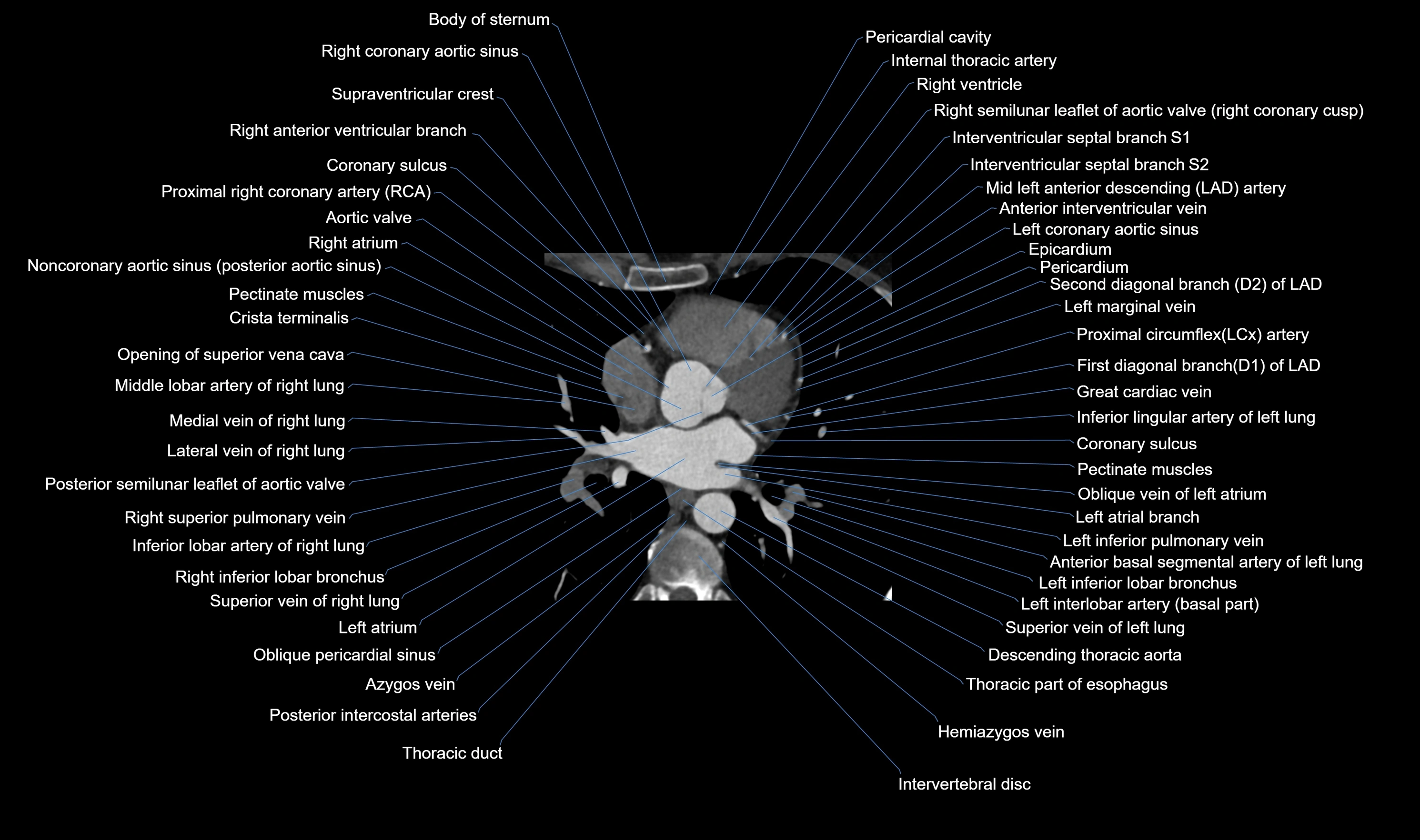 CT heart (coronary angiogram) axial view cross sectional anatomy labelled radiology image-00028.webp